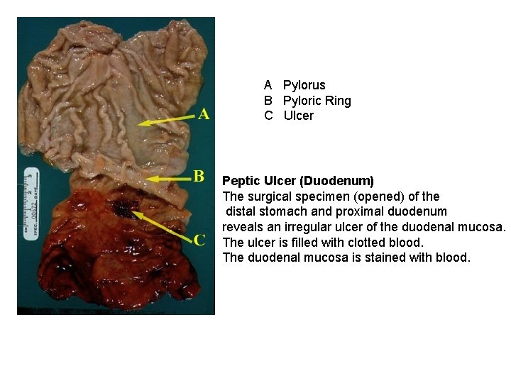 A Pylorus B Pyloric Ring C Ulcer Peptic Ulcer (Duodenum) The surgical specimen (opened)