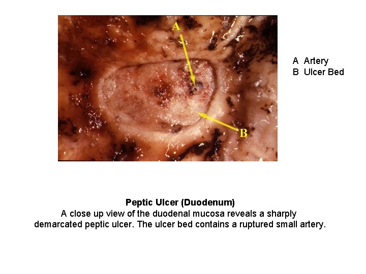 A Artery B Ulcer Bed Peptic Ulcer (Duodenum) A close up view of the