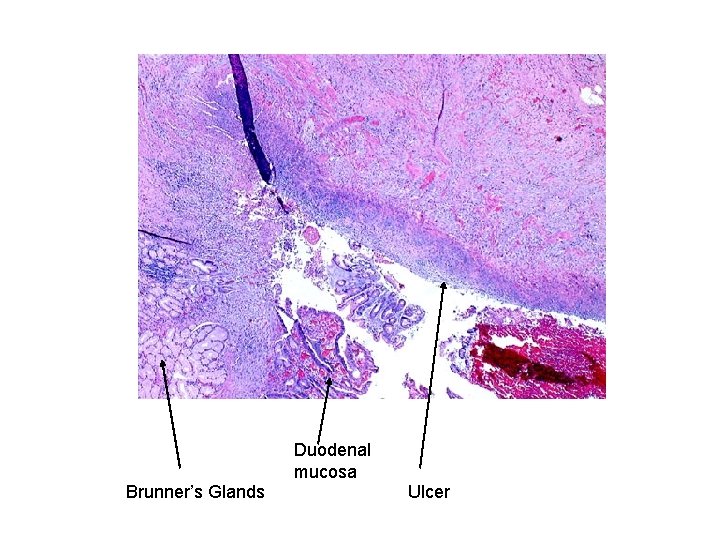 Duodenal mucosa Brunner’s Glands Ulcer 