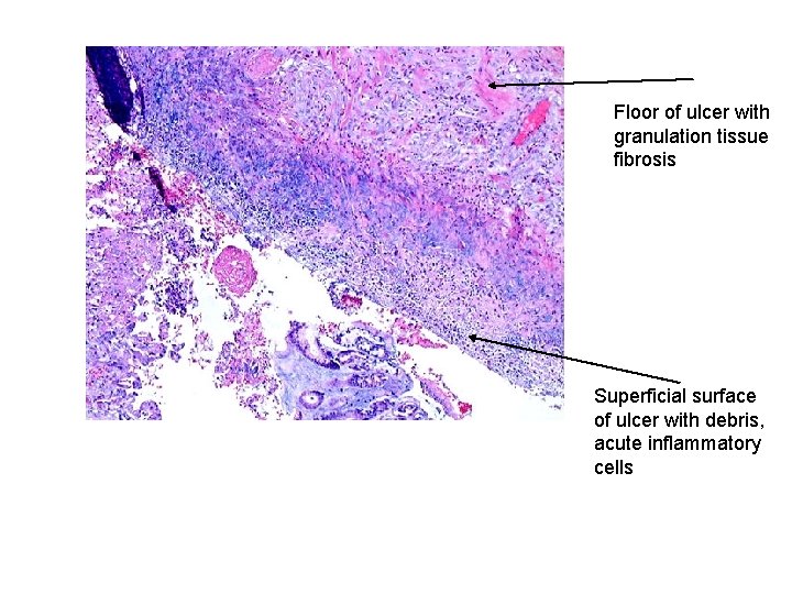 Floor of ulcer with granulation tissue fibrosis Superficial surface of ulcer with debris, acute