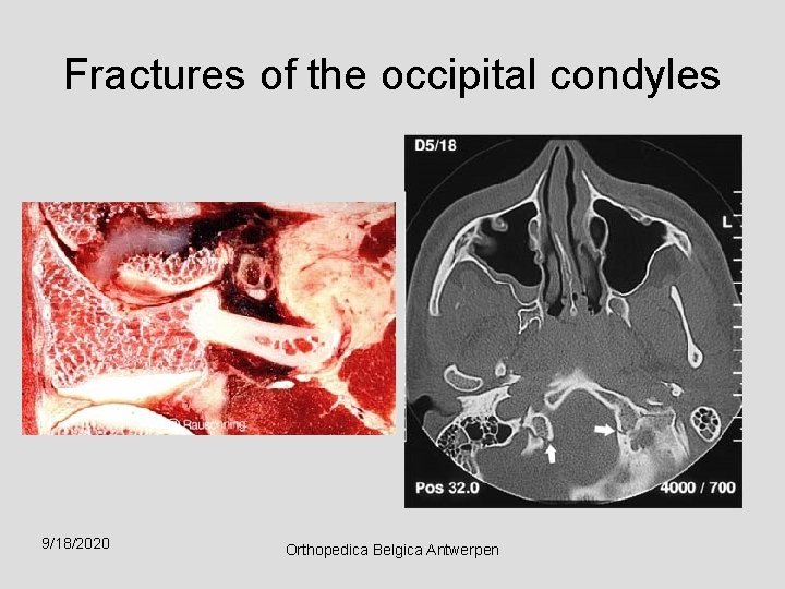 Fractures of the occipital condyles 9/18/2020 Orthopedica Belgica Antwerpen 
