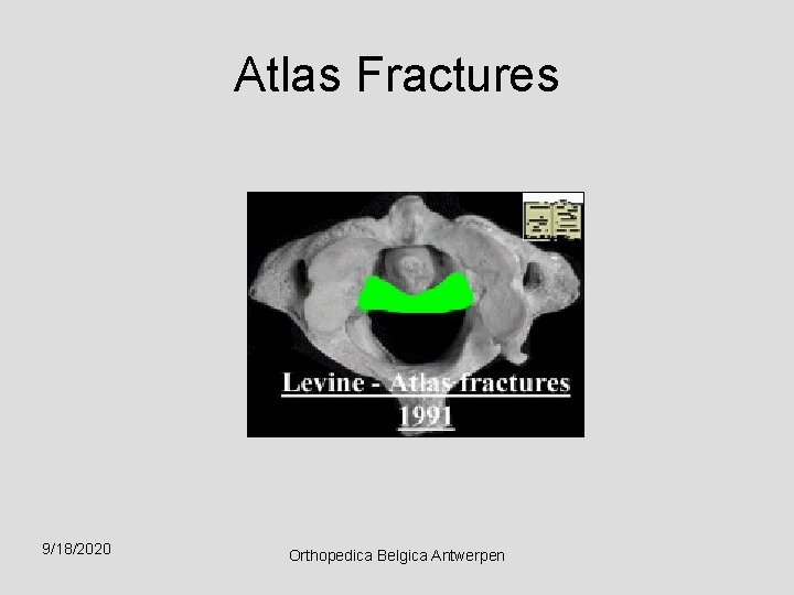 Atlas Fractures 9/18/2020 Orthopedica Belgica Antwerpen 