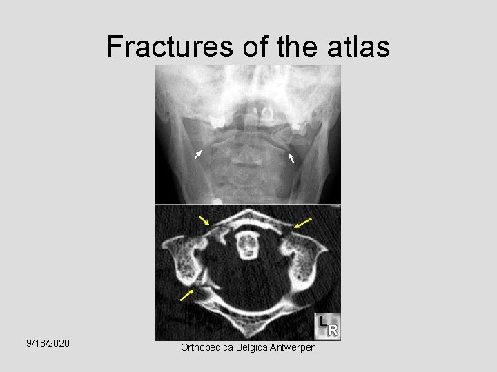 Fractures of the atlas 9/18/2020 Orthopedica Belgica Antwerpen 