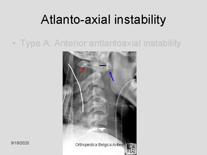 Atlanto-axial instability • Type A: Anterior antlantoaxial instability 9/18/2020 Orthopedica Belgica Antwerpen 