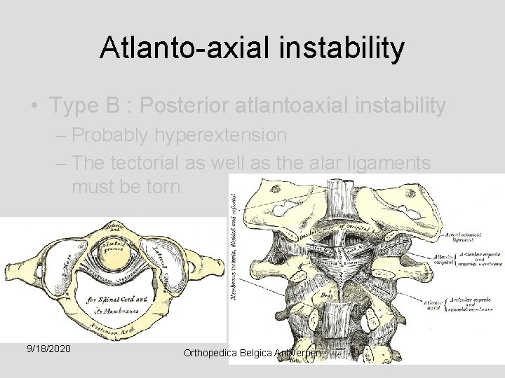 Atlanto-axial instability • Type B : Posterior atlantoaxial instability – Probably hyperextension – The