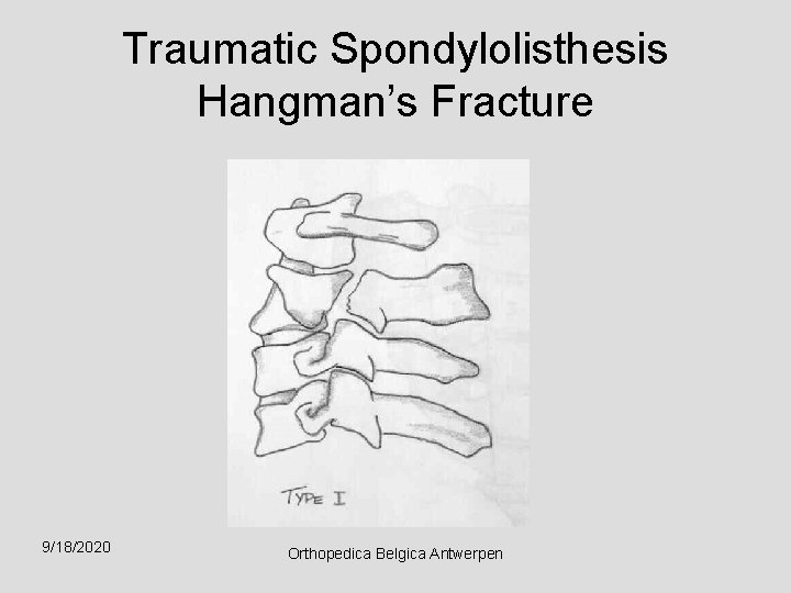 Traumatic Spondylolisthesis Hangman’s Fracture 9/18/2020 Orthopedica Belgica Antwerpen 
