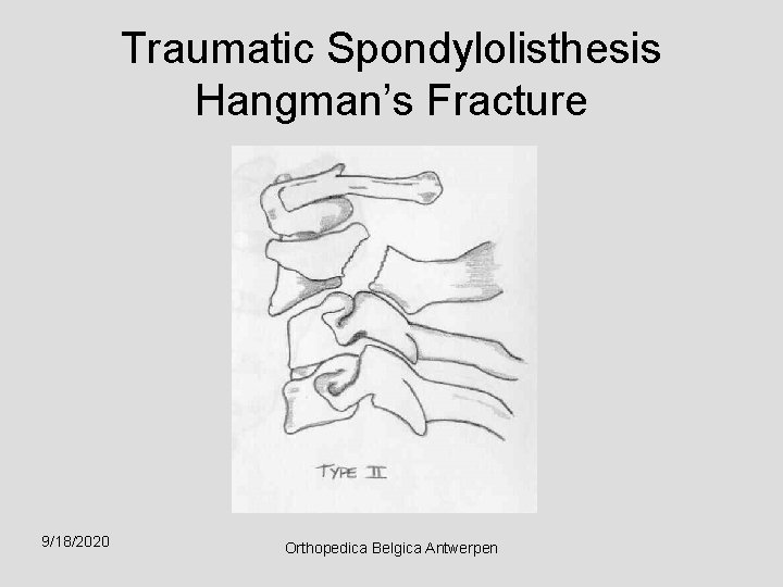 Traumatic Spondylolisthesis Hangman’s Fracture 9/18/2020 Orthopedica Belgica Antwerpen 