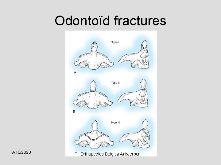 Odontoïd fractures 9/18/2020 Orthopedica Belgica Antwerpen 