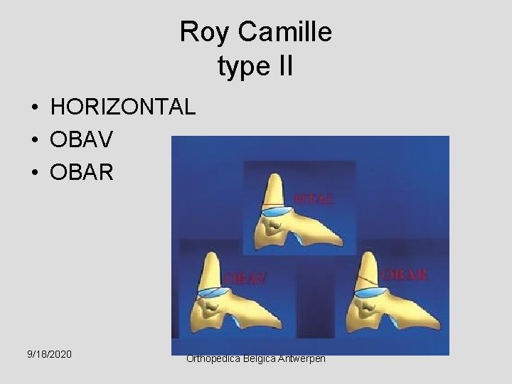Roy Camille type II • HORIZONTAL • OBAV • OBAR 9/18/2020 Orthopedica Belgica Antwerpen