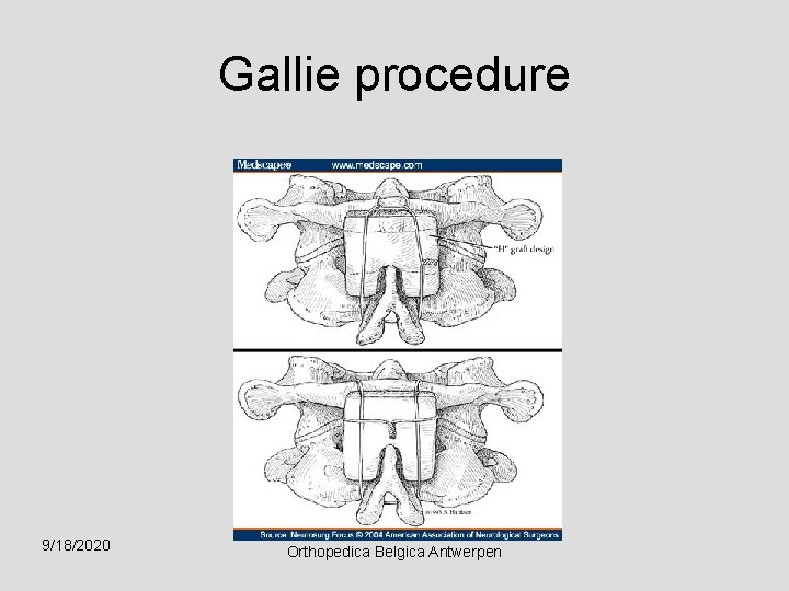 Gallie procedure 9/18/2020 Orthopedica Belgica Antwerpen 