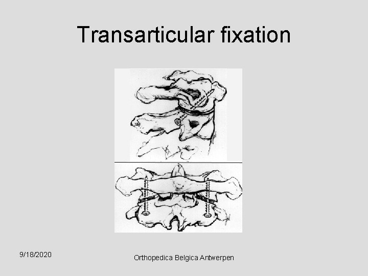 Transarticular fixation 9/18/2020 Orthopedica Belgica Antwerpen 