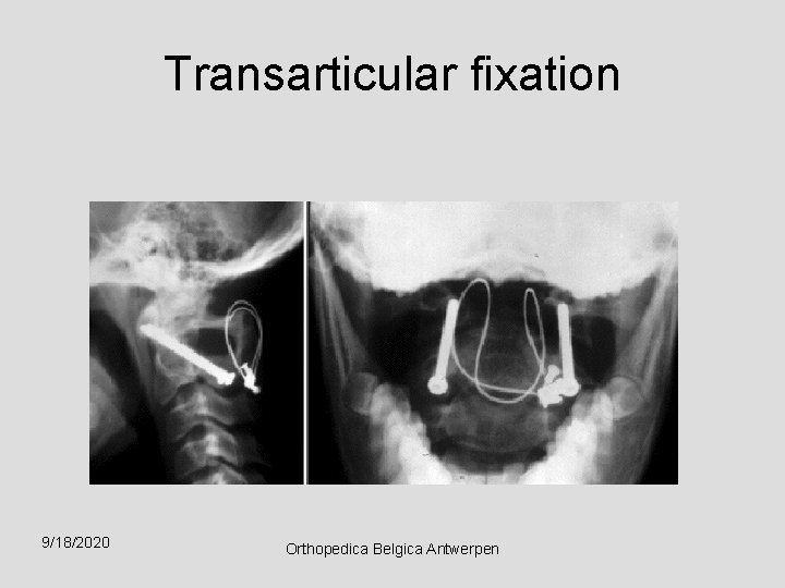 Transarticular fixation 9/18/2020 Orthopedica Belgica Antwerpen 