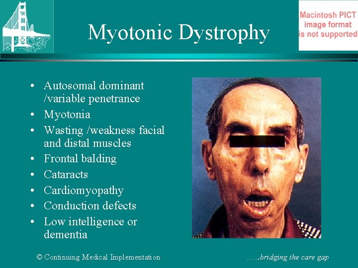 Myotonic Dystrophy • Autosomal dominant /variable penetrance • Myotonia • Wasting /weakness facial and