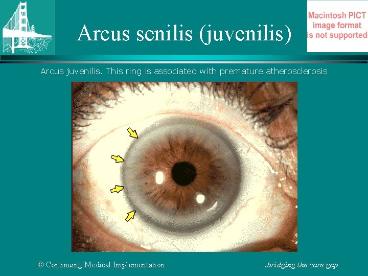 Arcus senilis (juvenilis) Arcus juvenilis. This ring is associated with premature atherosclerosis © Continuing