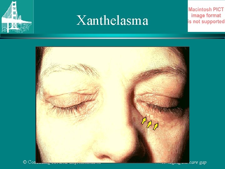 Xanthelasma © Continuing Medical Implementation …. . . bridging the care gap 