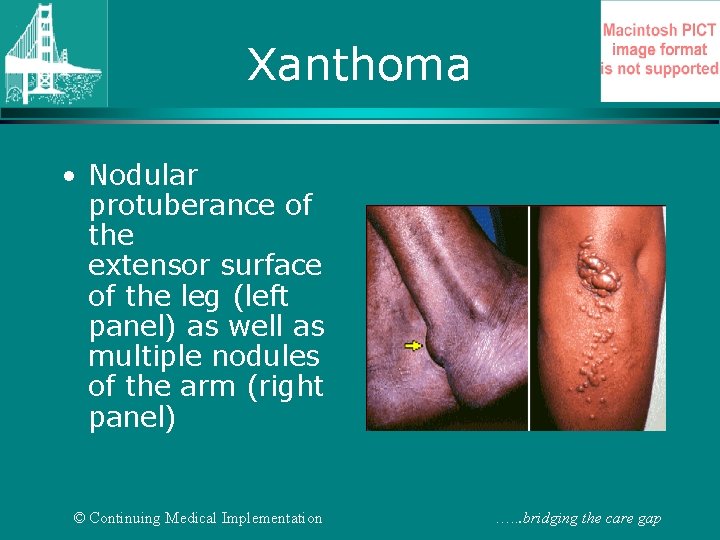 Xanthoma • Nodular protuberance of the extensor surface of the leg (left panel) as