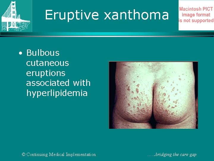 Eruptive xanthoma • Bulbous cutaneous eruptions associated with hyperlipidemia © Continuing Medical Implementation ….