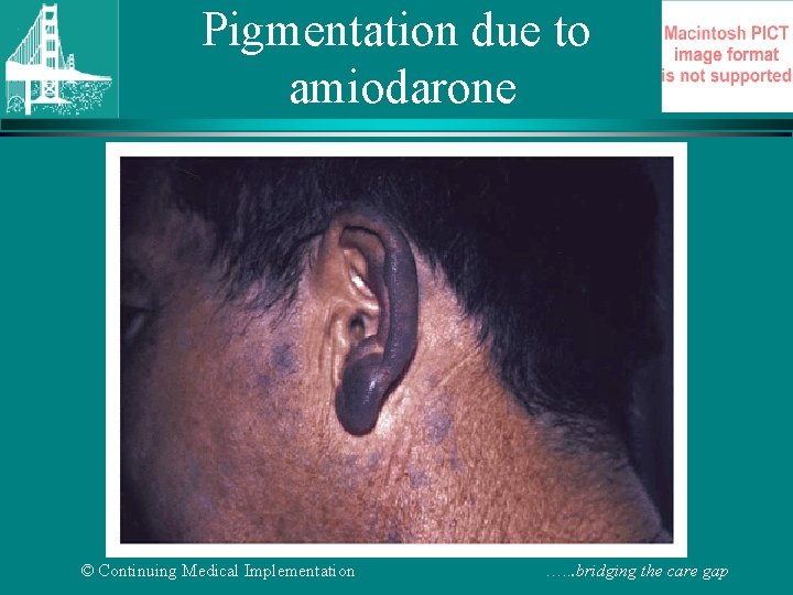 Pigmentation due to amiodarone © Continuing Medical Implementation …. . . bridging the care