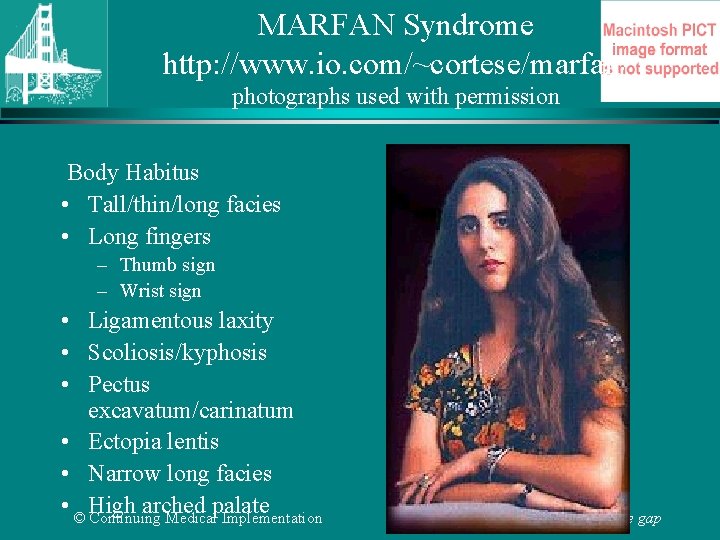 MARFAN Syndrome http: //www. io. com/~cortese/marfan/ photographs used with permission Body Habitus • Tall/thin/long