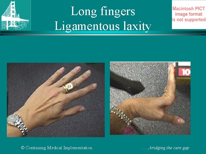 Long fingers Ligamentous laxity © Continuing Medical Implementation …. . . bridging the care