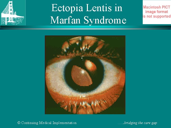 Ectopia Lentis in Marfan Syndrome © Continuing Medical Implementation …. . . bridging the