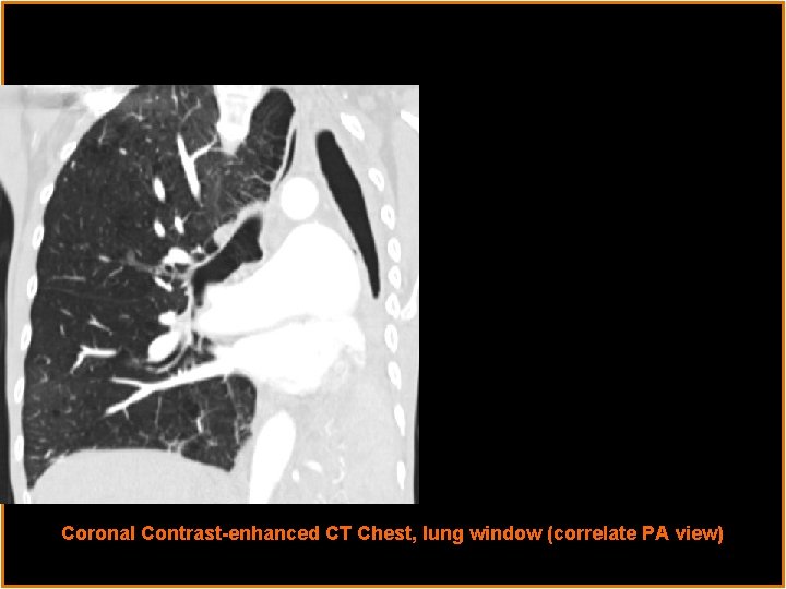 Radiological Presentations Coronal Contrast-enhanced CT Chest, lung window (correlate PA view) 