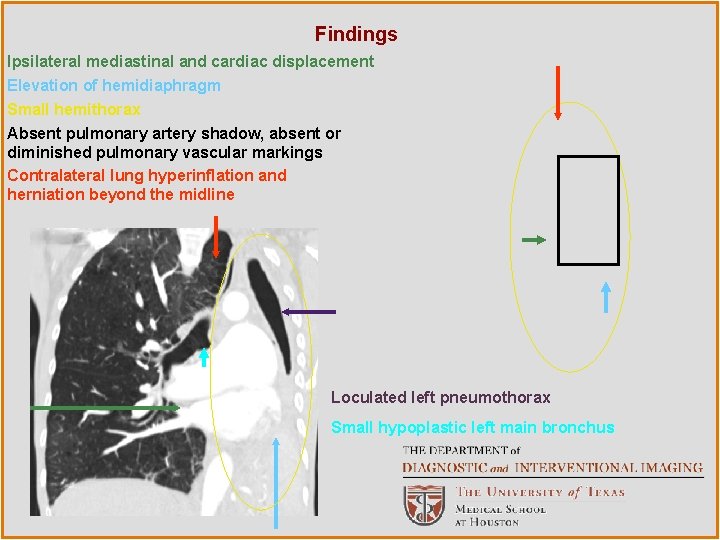 Findings Ipsilateral mediastinal and cardiac displacement Elevation of hemidiaphragm Small hemithorax Absent pulmonary artery