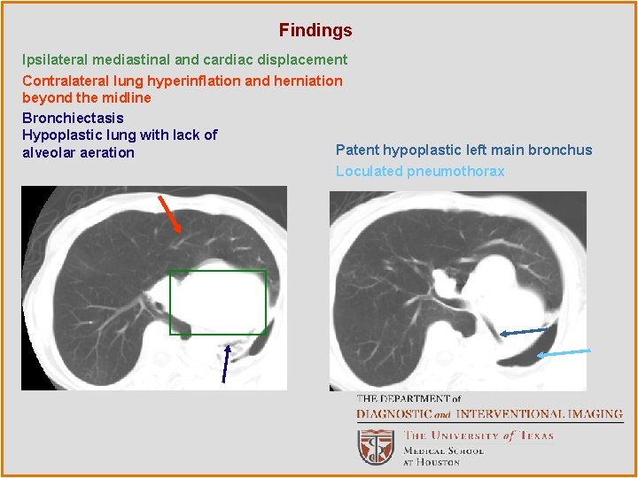 Findings Ipsilateral mediastinal and cardiac displacement Contralateral lung hyperinflation and herniation beyond the midline