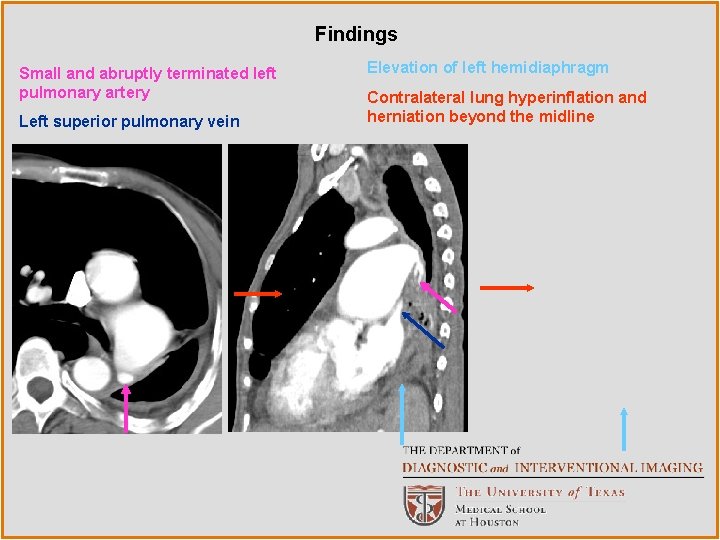 Findings Small and abruptly terminated left pulmonary artery Left superior pulmonary vein Elevation of