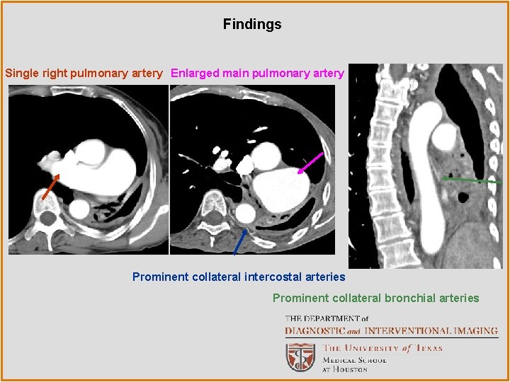 Findings Single right pulmonary artery Enlarged main pulmonary artery Prominent collateral intercostal arteries Prominent