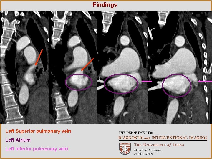 Findings Left Superior pulmonary vein Left Atrium Left Inferior pulmonary vein 