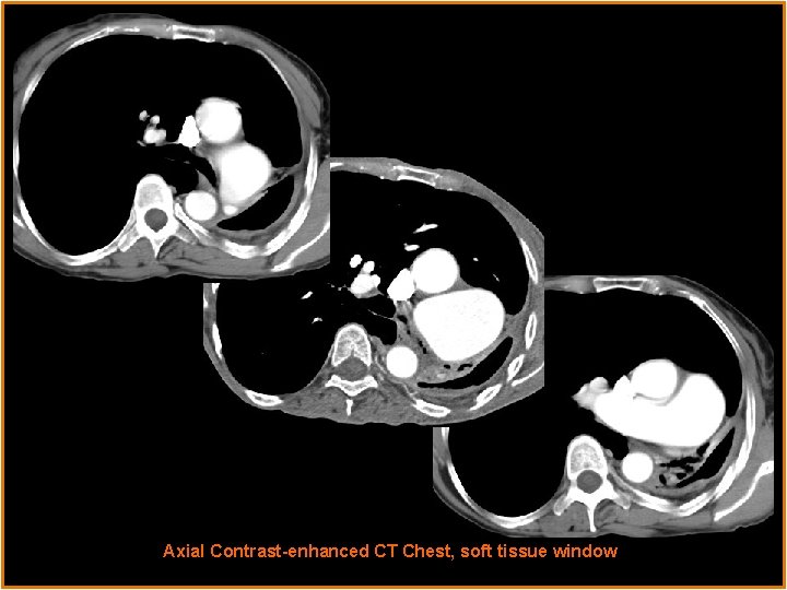 Radiological Presentations Axial Contrast-enhanced CT Chest, soft tissue window 