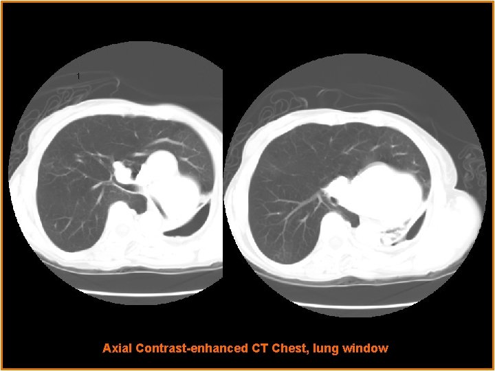 Radiological Presentations Axial Contrast-enhanced CT Chest, lung window 