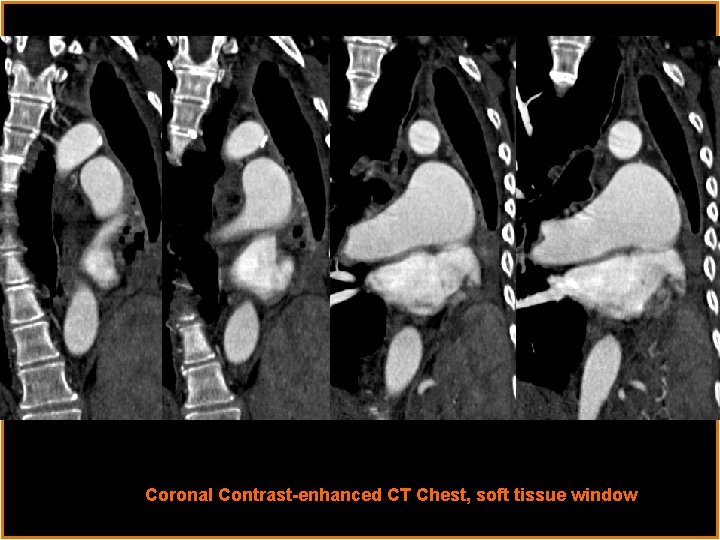 Coronal Contrast-enhanced CT Chest, soft tissue window 