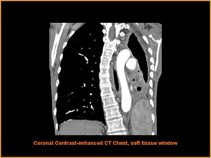 Radiological Presentations Coronal Contrast-enhanced CT Chest, soft tissue window 