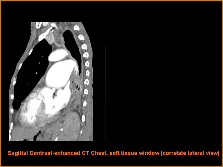 Sagittal Contrast-enhanced CT Chest, soft tissue window (correlateral view) 