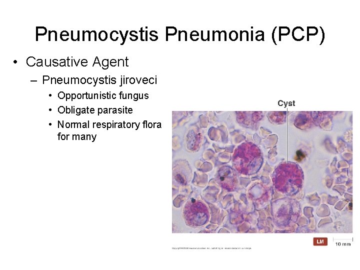 Pneumocystis Pneumonia (PCP) • Causative Agent – Pneumocystis jiroveci • Opportunistic fungus • Obligate
