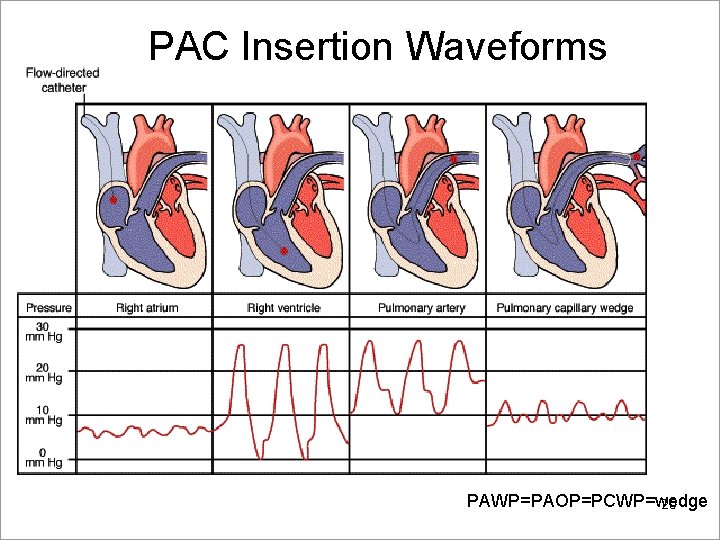 PAC Insertion Waveforms PAWP=PAOP=PCWP=wedge 25 