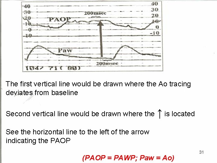 The first vertical line would be drawn where the Ao tracing deviates from baseline
