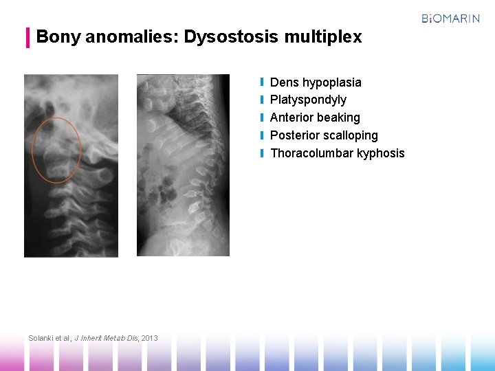 Bony anomalies: Dysostosis multiplex Dens hypoplasia Platyspondyly Anterior beaking Posterior scalloping Thoracolumbar kyphosis Solanki