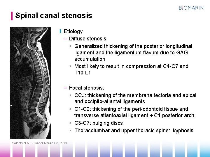 Spinal canal stenosis Etiology – Diffuse stenosis: § Generalized thickening of the posterior longitudinal