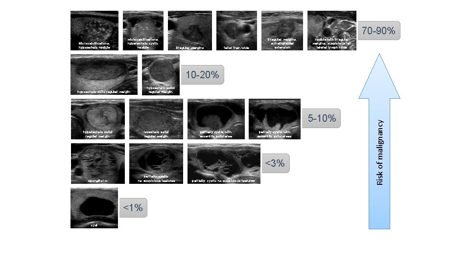 70 -90% Microcalcifications, hypoechoic nodule microcalcifications, hyperechoic cystic nodule irregular margins taller than wide