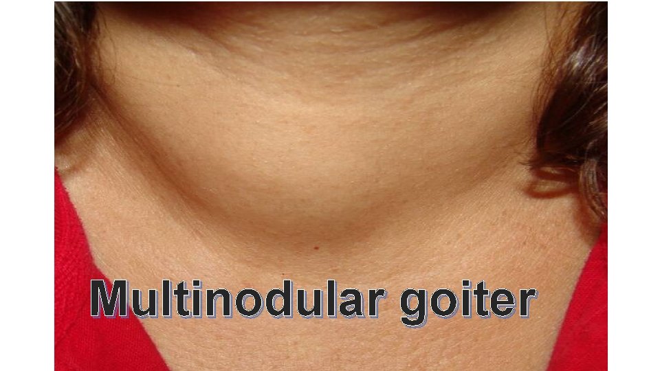 Multinodular goiter 
