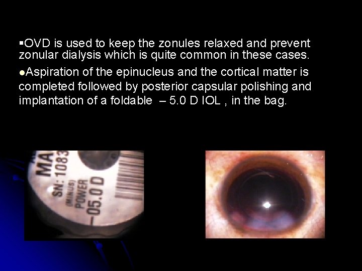 Clear Lens Extraction with Implantation of 5 0