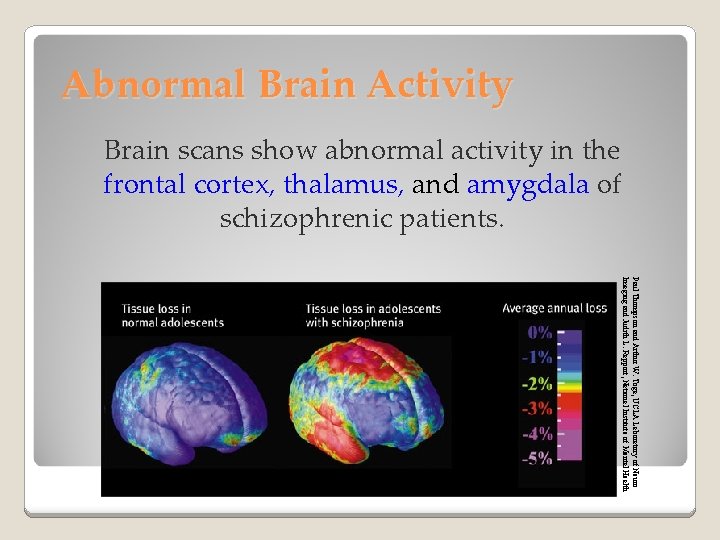 Abnormal Brain Activity Brain scans show abnormal activity in the frontal cortex, thalamus, and