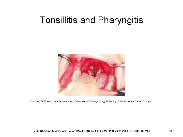 Tonsillitis and Pharyngitis Copyright © 2015, 2011, 2007, 2003, 1999 by Mosby, Inc. ,