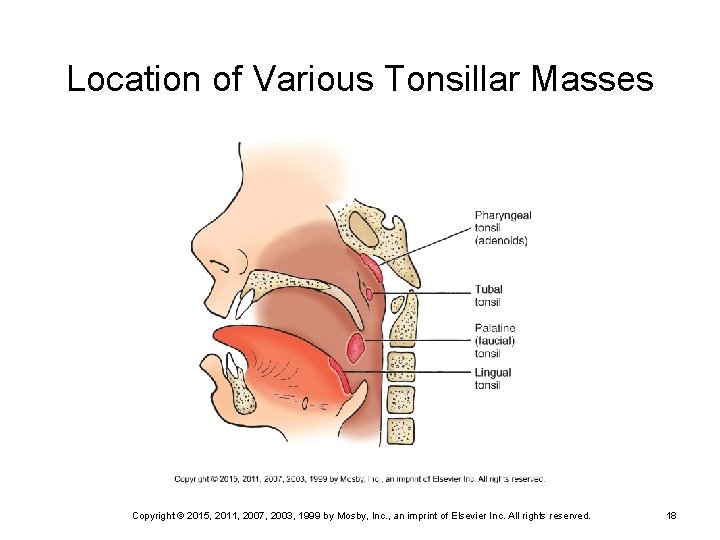 Location of Various Tonsillar Masses Copyright © 2015, 2011, 2007, 2003, 1999 by Mosby,