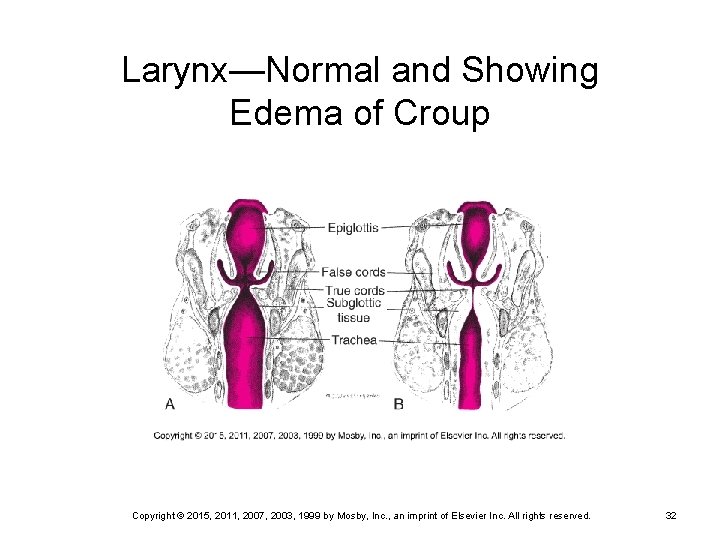 Larynx—Normal and Showing Edema of Croup Copyright © 2015, 2011, 2007, 2003, 1999 by