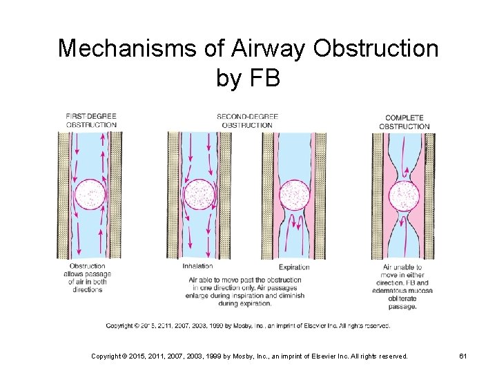 Mechanisms of Airway Obstruction by FB Copyright © 2015, 2011, 2007, 2003, 1999 by
