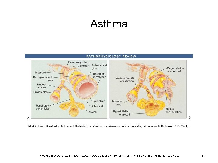 Asthma Copyright © 2015, 2011, 2007, 2003, 1999 by Mosby, Inc. , an imprint